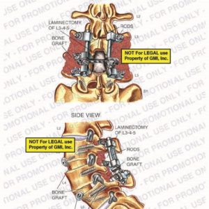 The exhibit illustrates a post-op condition of the lumbar spine, with posterior and side views, showing laminectomy of L3-4-5, rods, bone graft, and screws.