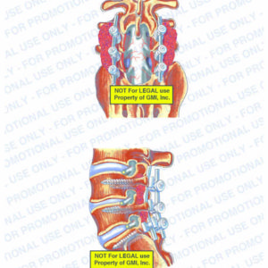The exhibit illustrates a laminectomy of L3-S1, with posterior and side views, showing rods, pedicle screws, bone graft, nerve root, and the exposed dural sac containing cauda equina of spinal cord.