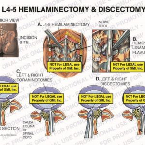 The exhibit illustrates hemilaminectomy and discectomy of the lumbar spine, with posterior and cross section views, showing incision site, L4-5 hemilaminectomy, nerve root, removal of ligamentum flavum, left and right foraminotomies, cauda equina of spinal cord, and left and right discectomies.