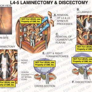 The exhibit illustrates a L4-5 laminectomy and discectomy, with posterior and cross section views, showing the incision site, removal of L4 & L5 spinous processes, L4 laminectomy, removal of ligamentum flavum, L5-S1 laminectomy, nerve root, cauda equina of spinal cord, left and right foraminotomies, and discectomy.