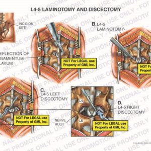 The exhibit illustrates a laminotomy and a discectomy of the lumbar spine showing incision site, reflection of ligamentum flavum, L4-5 laminotomy, L4-5 left and right discectomies, and nerve root.