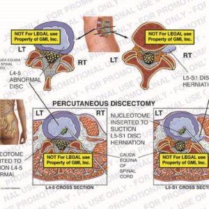 The exhibit illustrates a percutaneous discectomy of lumbar spine, with a cross section view, showing cauda equina of spinal cord, L4-5 abnormal disc, L5-S1 disc herniation nucleotome inserted to suction L4-5 abnormal disc, and nucleotome inserted to suction L5-S1 disc herniation.