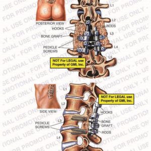The exhibit illustrates the post-op condition of lumbar spine, with posterior and side views, showing hooks, bone graft, pedicle screws, and rods.