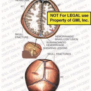 The exhibit illustrates post birth injury condition of a child/ baby brain, with axial cross section and posterior views, showing cephalo-hematoma, skull fracture, hemorrhagic brain contusion, subarachnoid hemorrhage, and shearing lesions indicating brain damage.