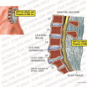The exhibit illustrates a post-op lumbar spine from a sagittal section view showing recurrent L3-4 disc bulge, L4-5 disc herniation, L5-S1 disc herniation, cauda equina of spinal cord, and scar tissue.