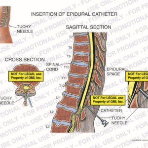The exhibit illustrates insertion of epidural catheter into the spine, with sagittal and cross section views, showing tuohy needle, spinal cord, epidural space, and catheter performing a T12-L1 epidural injection.