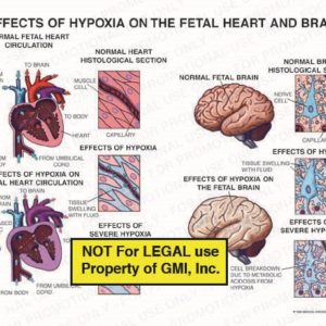 The exhibit illustrates the effects of hypoxia on the fetal heart and brain, along side a normal heart and brain.