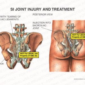 The exhibit illustrates SI joint injury and treatment, with a posterior view, showing injection into sacroiliac joint, sprain with tearing of sacroiliac ligaments, pelvis, iliac crest, and sacrum.