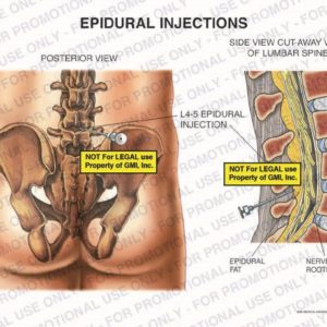 The exhibit illustrates an epidural injection in lumbar spine with posterior and side cut-away views of lumbar spine showing L4-5 epidural injection, epidural fat, and nerve roots.