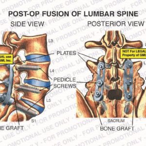 The exhibit illustrates post-op fusion of lumbar spine, with side and posterior views, showing bone graft, L3, L4, L5, S1, plates, sacrum and pedicle screws.