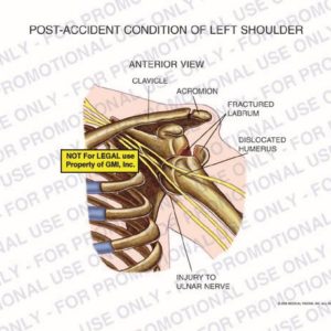 The exhibit illustrates the post-accident pre-op condition of the left shoulder with an anterior view showing clavicle, acromion, fractured labrum, dislocated humerus, and injury to ulnar nerve.