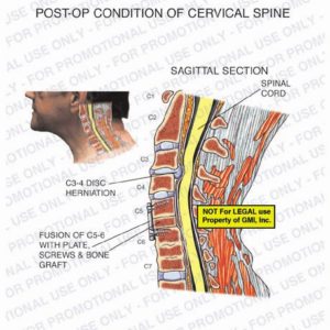 The exhibit illustrates the post-op condition of the cervical spine with a sagittal section view of C3-4 disc herniation and fusion of C5-6 with plate, screws, and bone graft.