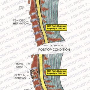 The exhibit illustrates pre-op and post-op anterior fusion conditions of the cervical spine, with a sagittal section view, showing C3-4 disc herniation and plate and screws utilizing bone graft.