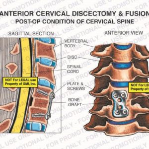 The exhibit illustrates the post-op condition of an anterior cervical discectomy and fusion of the cervical spine, with sagittal section and anterior views, showing the vertebral body, disc, spinal cord, plate and screws, and bone graft.