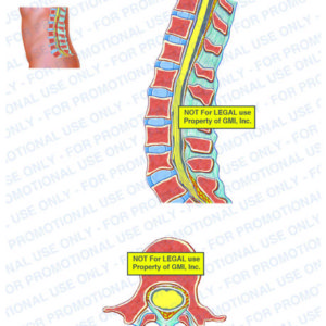 The exhibit illustrates the pre-op condition of the TLS spine, with sagittal and cross section views, showing the spinal cord, epidural hematoma, cauda equina, and vertebral body of L1.