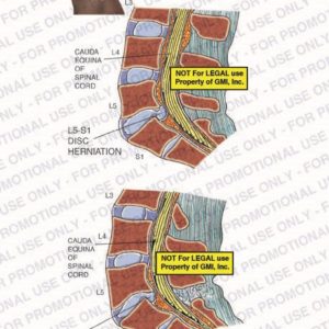 The exhibit illustrates a post-accident spine herniation vs. recurrent herniation showing cauda equina of spinal cord, L5-S1 disc herniation, and recurrent L5-S1 disc herniation.