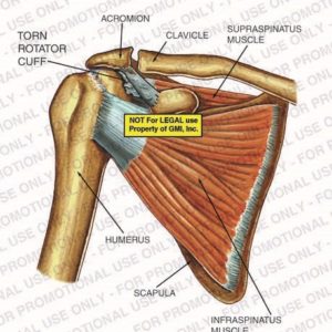 The exhibit illustrates a torn rotator cuff of the shoulder showing the acromion, clavicle, supraspinatus muscle, humerus, scapula, and infraspinatus muscle.