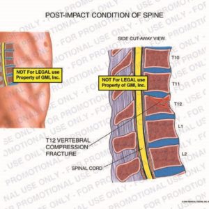 The exhibit illustrates the pre-op post-impact condition of the thoracic spine, with a side cut-away view, showing T12 vertebral compression fracture.