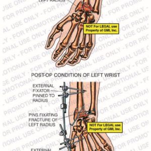 The exhibit illustrates pre-op vs. post-op conditions of left wrist showing fracture of left radius, external fixator pinned to radius, pins fixating fracture of left radius, and external fixator pinned to index finger metacarpal.