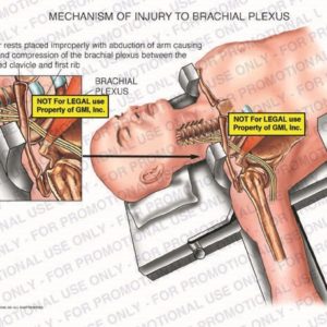 The exhibit illustrates the mechanism of injury to the brachial plexus showing shoulder rests placed improperly with abduction of arm causing stretch and compression of the brachial plexus between the depressed clavicle and first rib.