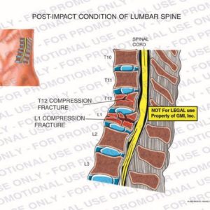 The exhibit illustrates the pre-op post-impact condition of the lumbar spine showing the T12 and L1 compression fractures pressing on the spinal cord.