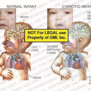 The exhibit illustrates a normal infant vs. cyanotic infant showing brain, right lung, left lung, heart, oxygen deprived brain, oxygen deprived lungs, and oxygen deprived heart.