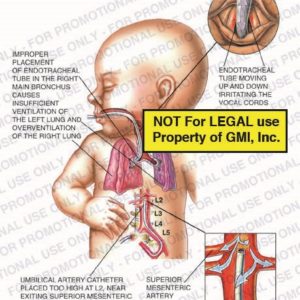 The exhibit illustrates an infant with an endotracheal tube that has been improperly placed showing improper placement of endotracheal tube in the right main brochus causing insufficient ventilation of the left lung and over-ventilation of the right lung, umbilical artery catheter placed too high at L2 near existing superior mesenteric and renal arteries, endotracheal tube moving up and down irritating the vocal cords and superior mesenteric artery supplies intestines.