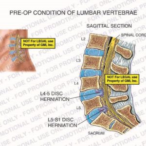 The exhibit illustrates the pre-op condition of the lumbar vertebrae, with a sagittal section view, showing a L4-5 disc herniation and L5-S1 disc herniation.