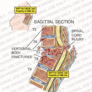 The exhibit illustrates a pre-op condition of the thoracic spine, with a sagittal section view, showing a spinal cord injury and vertebral body fractures of T5, T6, T7, and T8.