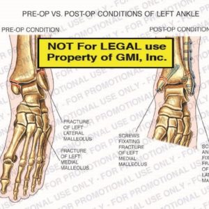 The exhibit illustrates pre-op vs. post-op conditions of left ankle showing pre-op condition with fracture of left lateral malleolus, fracture of left medial malleolus; and post-op condition with screws fixating fracture of left medial malleolus, and screws and plate fixating fracture of left lateral malleolus.