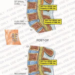 The exhibit illustrates pre-op versus post-op conditions of the lumbar spine including the cauda equina and L5-S1 disc herniation.