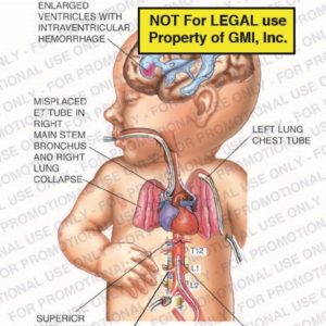 The exhibit illustrates an infant with enlarged ventricles with intraventricular hemorrhage showing misplaced endotracheal tube in right main stem bronchus and right lung collapse, superior mesenteric artery, renal artery, misplaced umbilical artery catheter at T12, and left lung chest tube.