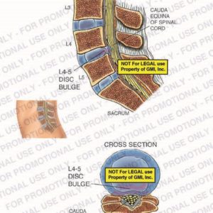 The exhibit illustrates a pre-op condition of the lumbar spine including, sagittal and axial cross section views, showing the L4-5 disc bulge, cauda equina, and sacrum.