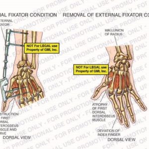 The exhibit illustrates an external fixator condition vs. removal of an external fixator condition with dorsal views showing external fixator, destruction of first dorsal interosseus muscle and nerve, mallunion of radius, atrophy of first dorsal interosseus muscle, and deviation of index finger.