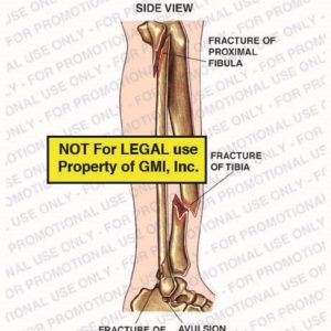 The exhibit illustrates a post-accident condition of right leg showing side view of fracture of proximal fibula, fracture of tibia, fracture of posterior malleolus and avulsion fracture of distal fibula.