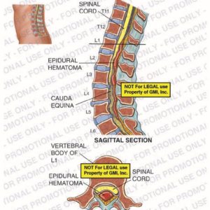 The exhibit illustrates the pre-op condition of the lumbar spine including, sagittal and axial cross section views, showing the spinal cord, epidural hematoma, cauda equina, and the vertebral body of L1.