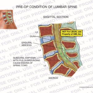 The exhibit illustrates the pre-op condition of the lumbar spine, with a sagittal section view, showing the dura, epidural abscess, subdural empyema with pus surrounding the cauda equina of the spinal cord, and the sacrum.
