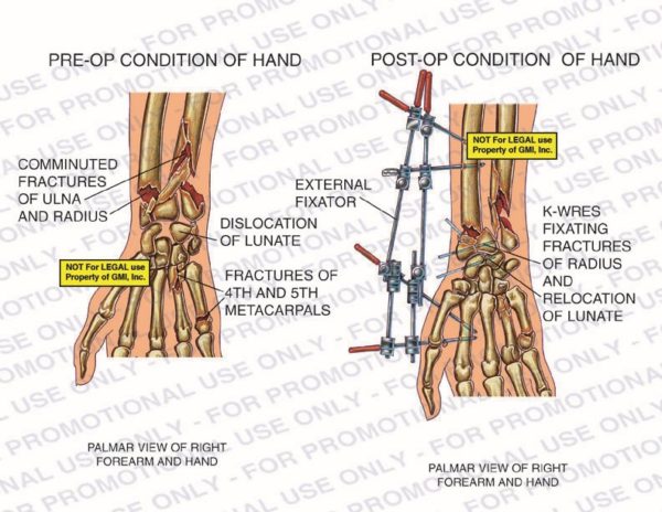 The exhibit illustrates pre-op and post-op conditions of hand with palmar view of right forearm and hand showing comminuted fractures of ulna and radius, dislocation of lunate, fractures of 4th and 5th metacarpals, external fixator and k-wires fixating fractures of radius and relocation of lunate.