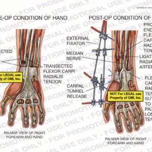 The exhibit illustrates pre-op vs. post-op conditions of hand with palmar view of right forearm and hand showing transected radial artery, transected flexor carpi radials tendon, external fixator, median nerve, carpal tunnel release, proximal end of flexor carpi radials tendon, ligated raial artery, and flexor carpi radials tendon sutured to palmaris longus tendon.