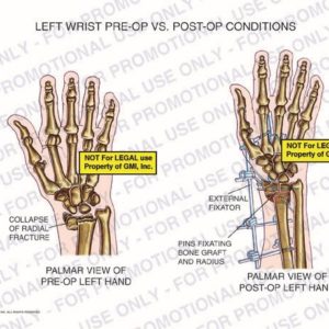 The exhibit illustrates pre-op vs. post-op conditions of left wrist with palmer views of left hand showing collapse of radial fracture, external fixator, and pins fixating bone graft and radius.
