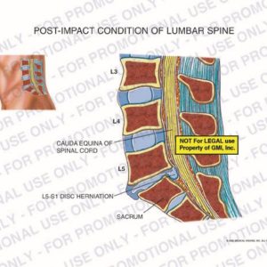 The exhibit illustrates the pre-op post-impact condition of the lumbar spine, including the cauda equina, L5-S1 disc herniation and the sacrum.