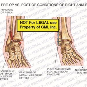 The exhibit illustrates pre-op vs. post-op conditions of right ankle showing pre-op with fracture of fibula, fracture of posterior malleolus of tibia, fracture of medial malleolus tibia; and post-op condition with plate and screws fixating fibular fracture and nonunion tibial fracture.