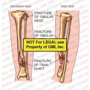 The exhibit illustrates post-op condition of left leg showing anterior view and side view of fracture of fibular head, fracture of fibular shaft and fracture of tibial shaft.