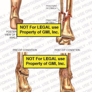 The exhibit illustrates post-accident conditions showing posterior view of left ankle; immediate post-accident condition with fracture of fibula, fracture of tibia; pre-op condition with nonunion of tibia; and post-op condition of bone grafted to nonunion of tibia.