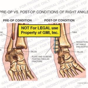The exhibit illustrates pre-op vs. post-op conditions of right ankle showing pre-op condition with fracture of fibula, ankle dislocation, tibia, talus; post-op condition with tibia, reduction of ankle dislocation, talus, and plate and screws fixating fracture.