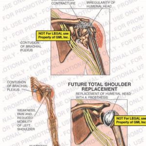 The exhibit illustrates current and future conditions of contusion of brachial plexus showing severe adhesive capsulitis and ligamentous contracture, collapse and irregularity of humeral head, weakness, pain and reduced mobility of left shoulder, numbness of fifth finger, and replacement of humeral head with a prosthesis.