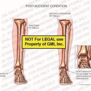 The exhibit illustrates post-accident conditions showing fracture of fibula and contusion of talar dome; and current condition with callous formation of fibula and contusion of talar dome with cartilaginous fragments.