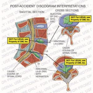 The exhibit illustrates post-accident discogram interpretations, with sagittal and cross section views, showing injection of dye into disc, abnormal L4-5 disc, cauda equina of spinal cord, and abnormal L5-S1 disc with herniation.