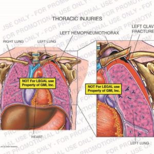 The exhibit illustrates thoracic injuries showing the right lung, left lung , left hemopneumothorax, heart, and left clavicle fracture.