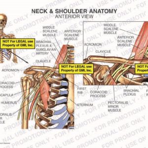 The exhibit illustrates the anatomy of the neck and shoulder, with an anterior view, showing the anterior scalene muscle, middle scalene muscle, brachial plexus, subclavian artery, clavicle, acromion, coracoid process, scapula, humerus, pectoralis minor muscle, first rib, and sternum.